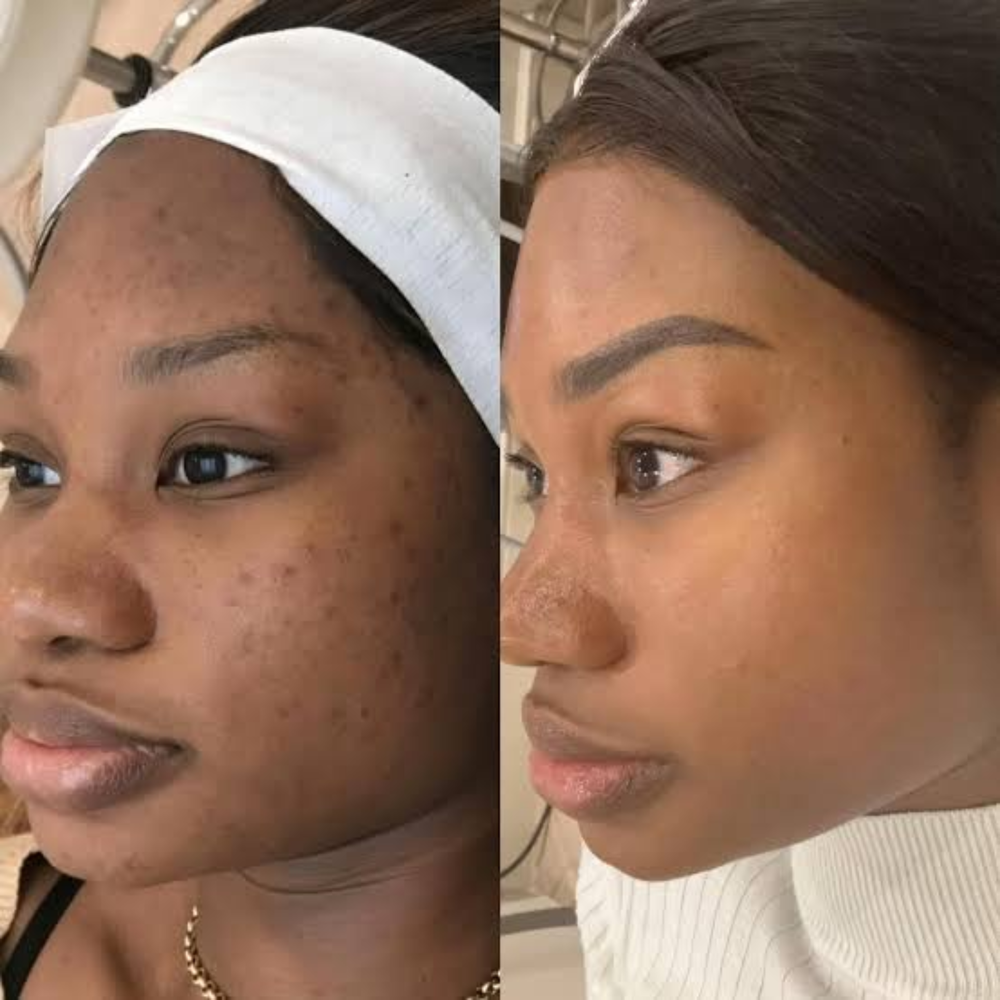 Before and after: dark spots and blemishes fading